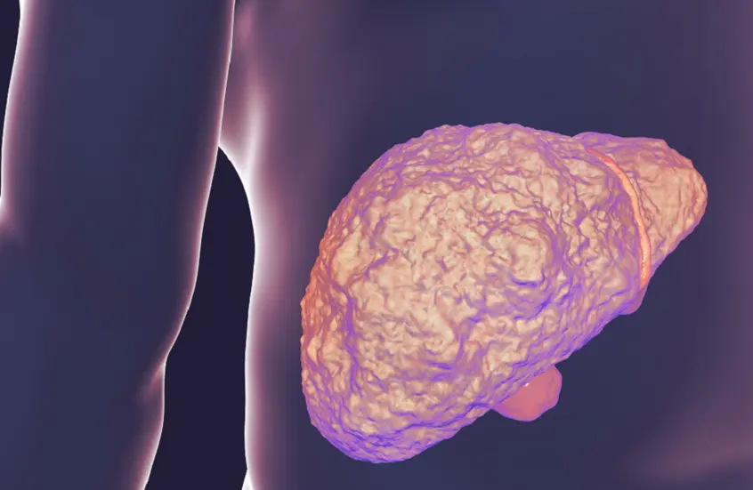 دور الكوليسترول في تدهور صحة الكبد